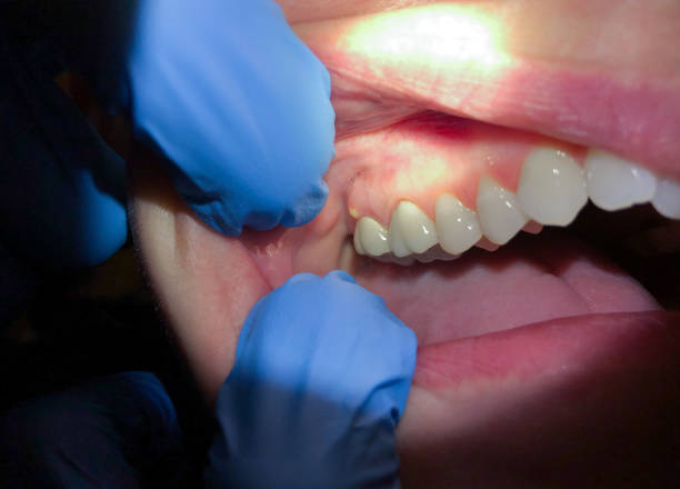 Best Emergency Dental Care for Abscessed Tooth in Chesterbrook, PA